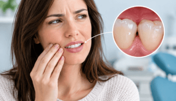 caries-interdental